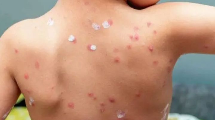Confirman primera muerte por varicela en Guanajuato este año; fue un niño de 8 años