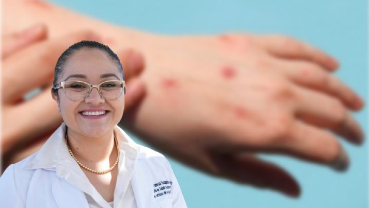 Llega a Hidalgo la viruela del mono, hay tres casos confirmados en estos municipios