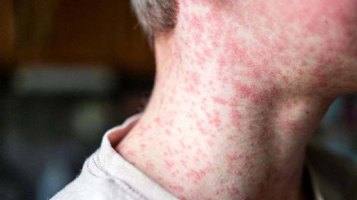 Sarampión y tos ferina ganan terreno en Hidalgo