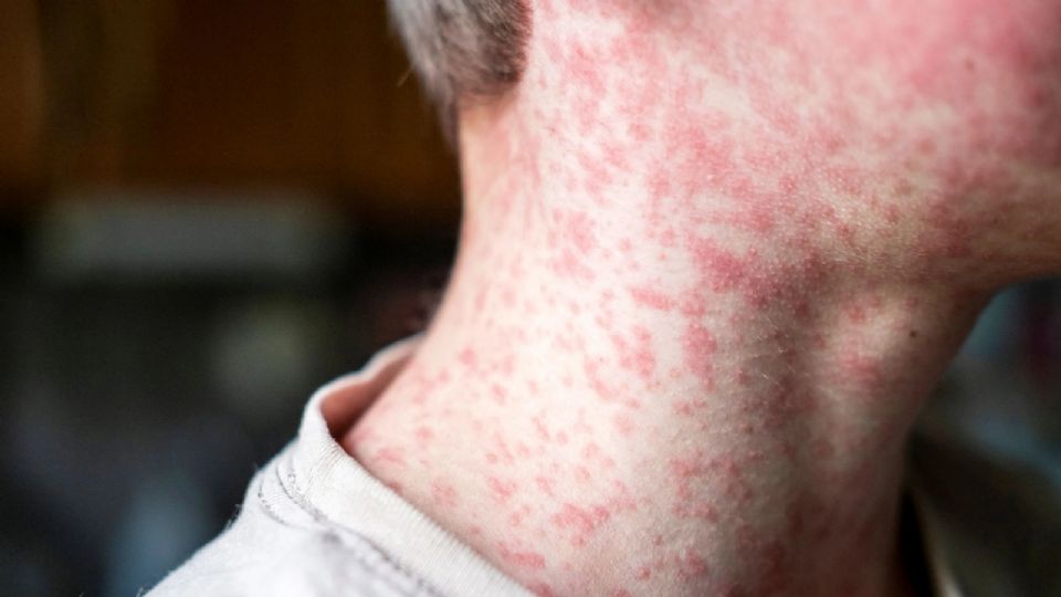 En Hidalgo se detectaron casi 60 casos posibles de personas contagiadas de sarampión