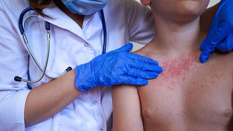 SSH confirma primer caso en Hidalgo