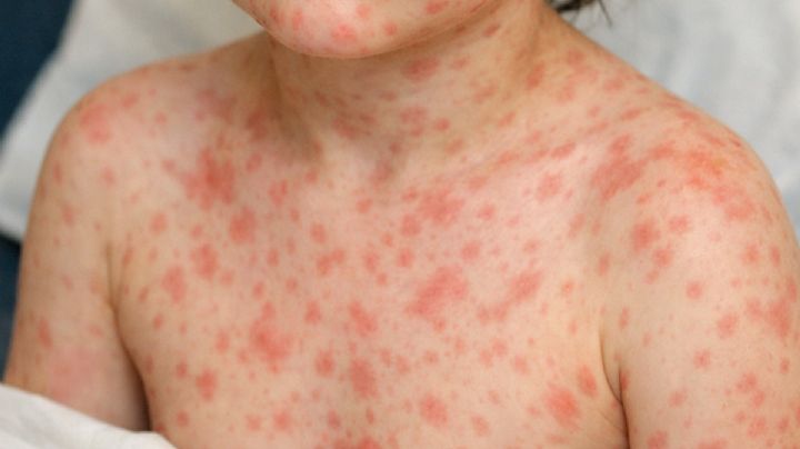 Niño fallece por complicaciones de sarampión; no contaba con vacunación completa