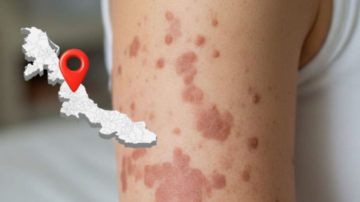 Confirmado: Xalapa registra el primer caso de sarampión en Veracruz, este 2026