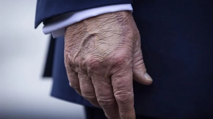 ¿Qué le pasa a Trump? Este sería el motivo de los moretones en sus manos