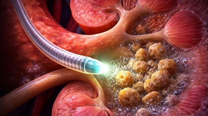 Micro robot lleva alivio a pacientes con piedras en el riñón