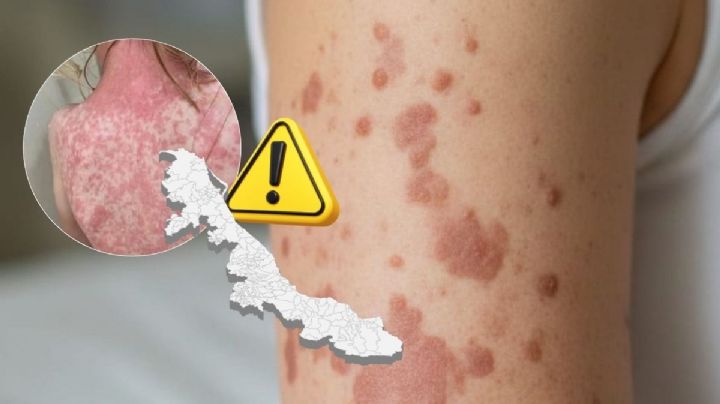 Confirman segundo caso de sarampión en Xalapa, los únicos en Veracruz con brote nacional