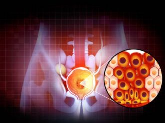 Microrrobots aniquilan las defensas del cáncer de próstata