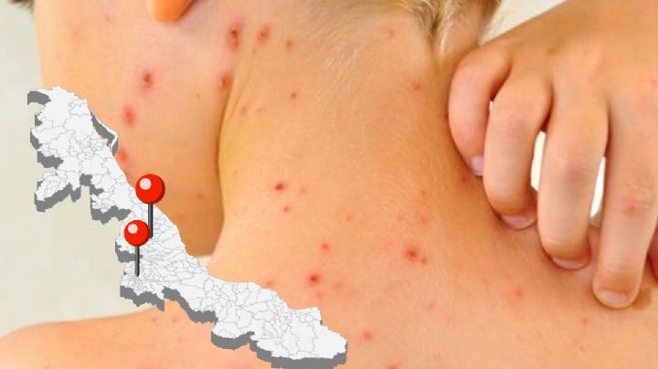 Sarampión llegó a Veracruz por Orizaba y Xalapa con brote nacional: confirma Salud federal