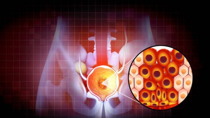 Microrrobots aniquilan las defensas del cáncer de próstata