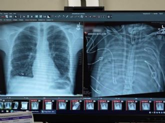 Hombre conectado a "pulmón artificial" sobrevive 48 horas con el tórax vacío