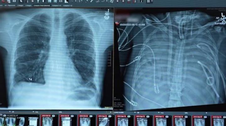 Hombre conectado a "pulmón artificial" sobrevive 48 horas con el tórax vacío