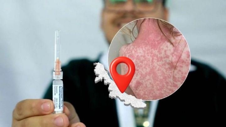 Sarampión en Veracruz: así puedes ubicar donde hay vacunación