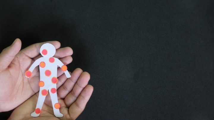 Hay nueve casos activos de sarampión en Hidalgo, la Secretaría de Salud alerta a la población