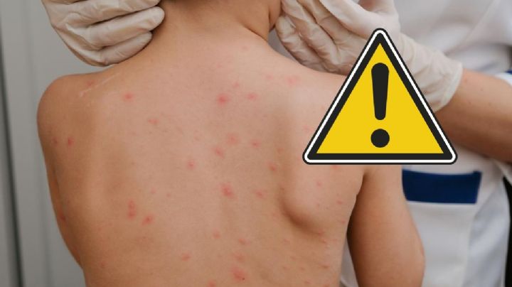 Sarampión en Veracruz: van 30 casos confirmados en lo que va del 2026