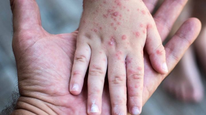 Estas son las ciudades de Hidalgo con más contagios de sarampión