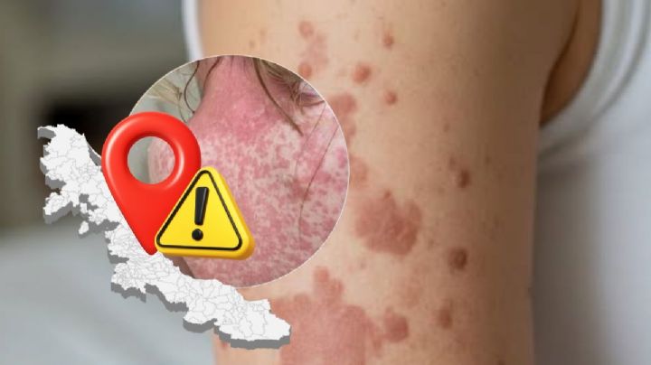 Sarampión en Veracruz: Altas Montañas concentra el brote, en estos 7 municipios