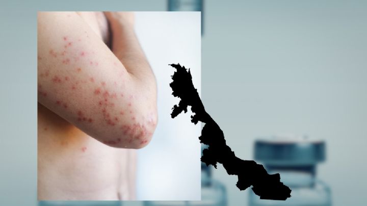 Veracruz suma 36 casos de sarampión; mayoría se detectó en febrero