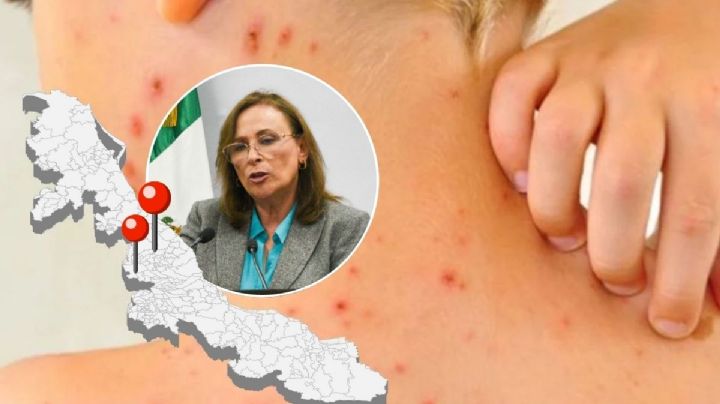 Repunta a 13 casos de sarampión en Veracruz en febrero, confirma Nahle
