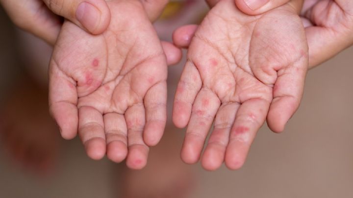 Suman 31 muertes por sarampión en México