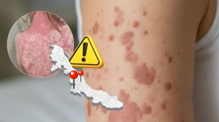 Sarampión en Veracruz repunta en febrero y alcanza a estos 7 municipios