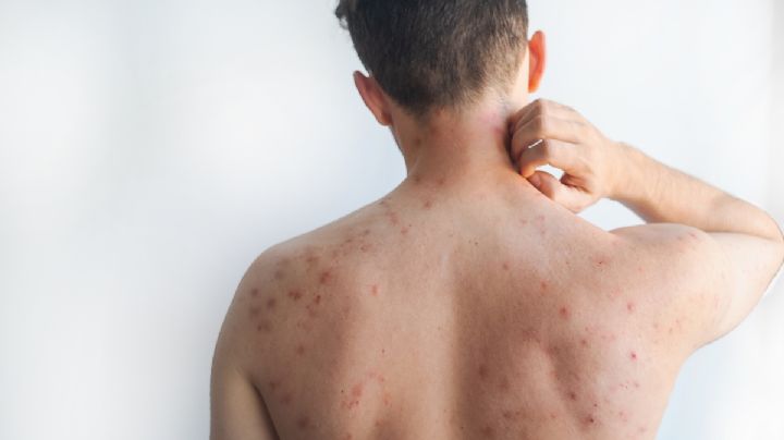 Sarampión y la responsabilidad de los Estados