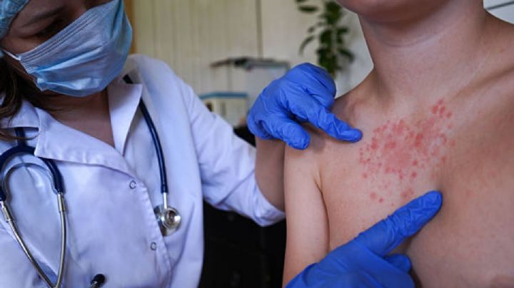 Sarampión en México: van 35 fallecimientos y más de 13,000 contagios