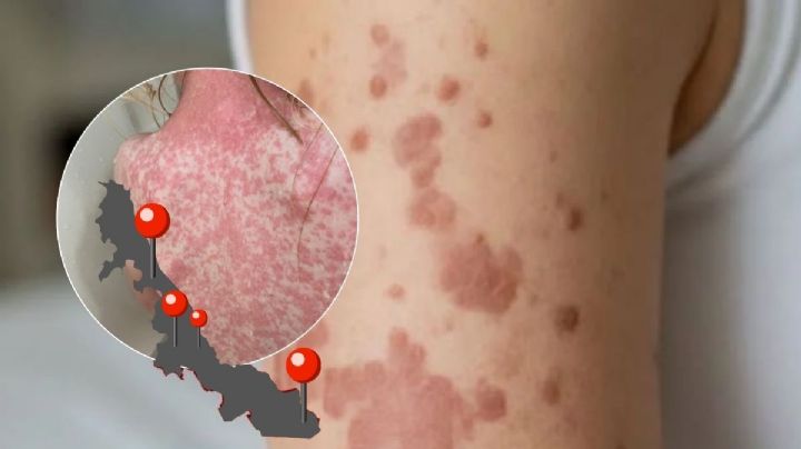 Sarampión se extiende en regiones de Veracruz y llega a estos 14 municipios