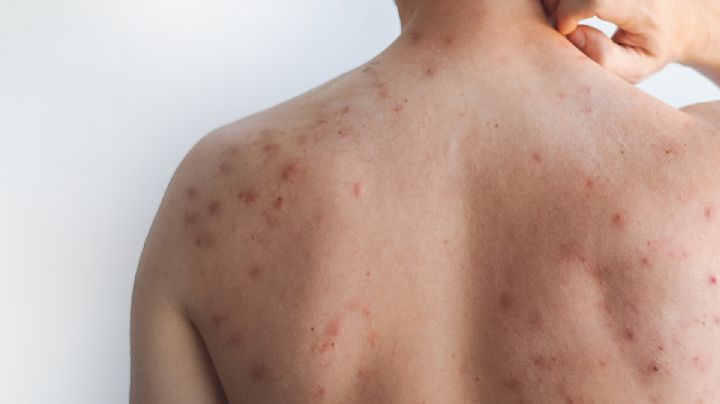 SSH intensifica brigadas de vacunación; hay cinco casos de sarampión activos