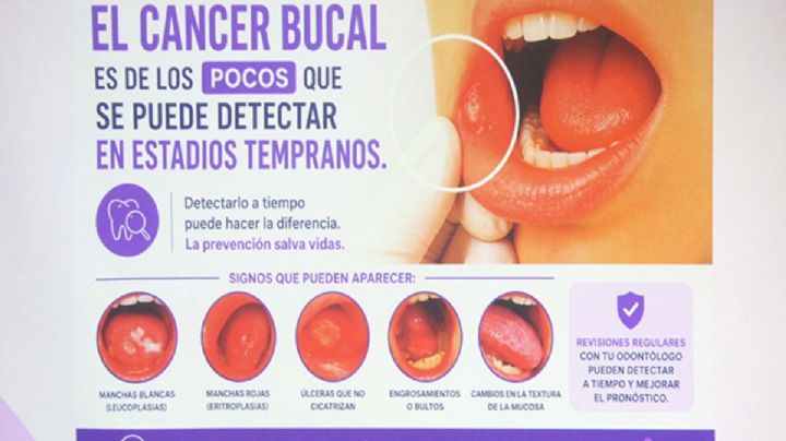 Autoexploración y visitas odontológicas, esenciales ante cáncer bucal