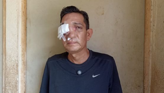Un tumor cancerígeno cubre la cara de Sergio: clama ayuda ante falta de atención en Veracruz